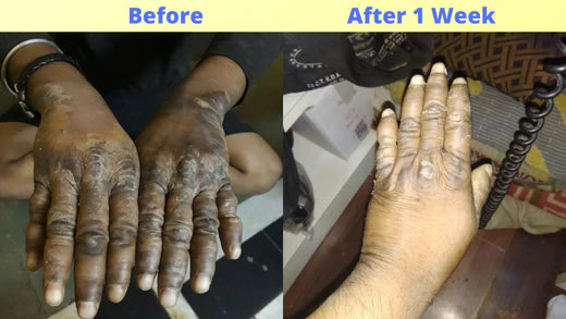 Big Difference for a Leprosy case using Barphani Cream